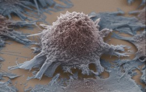Ограничение потребления раковыми клетками глюкозы может быть ключом к успешному лечению рака